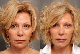Photo 1 before and after using Goji Cream