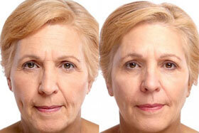Photo 3 before and after using Goji Cream