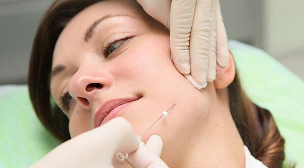 Thread lifting - a way to cosmetically rejuvenate the face after 45 years