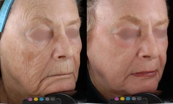 photo before and after laser rejuvenation