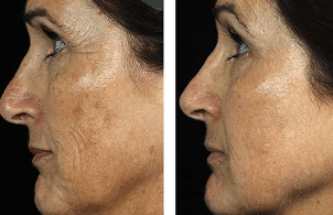 Before and after fractionated facial rejuvenation