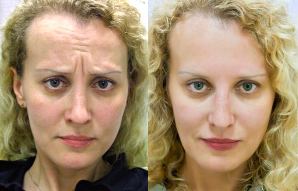 before and after using the massaging rejuvenator ltza photo 1