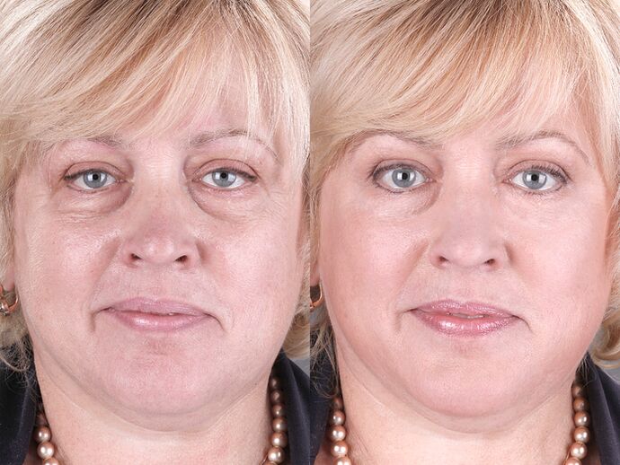 before and after using the massaging rejuvenator ltza photo 3