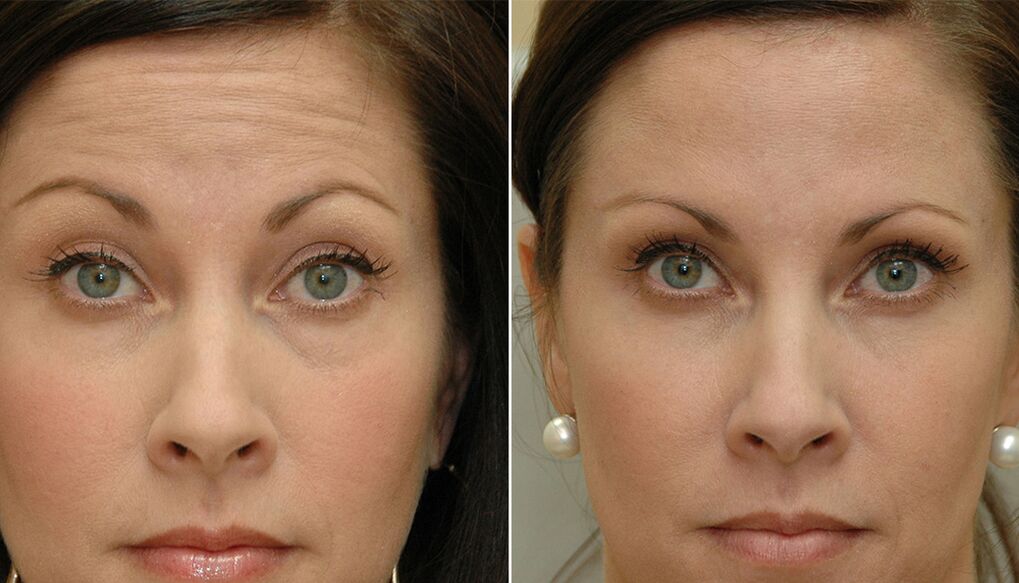 before and after using the massaging rejuvenator ltza photo 4