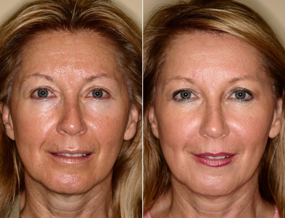 before and after using the massaging rejuvenator ltza photo 5