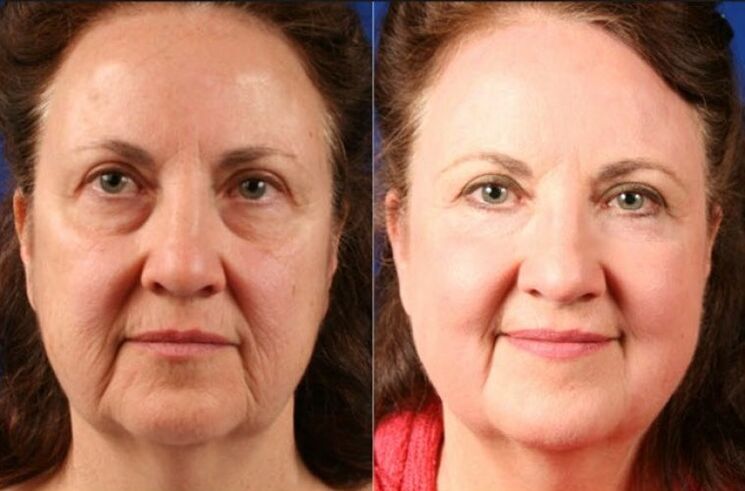 before and after using the massaging rejuvenator ltza photo 6