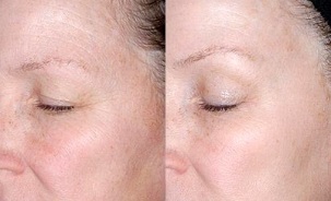 rejuvenating the skin around the eyes before and after the photos