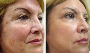 fractionated skin rejuvenation before and after photos