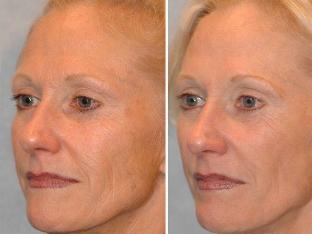 Before and after microconductive therapy