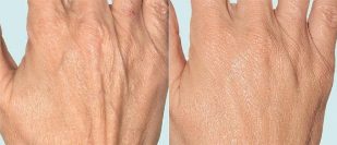 Hand skin before and after fractionated therapy