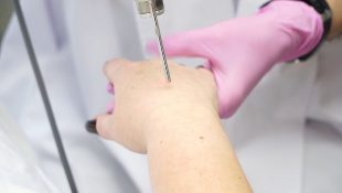 Laser rejuvenation of the skin of the hand