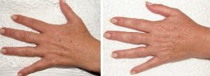 The result of removing old age spots on the hands