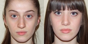 plasma before and after skin rejuvenation