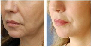 biological strengthening of the face